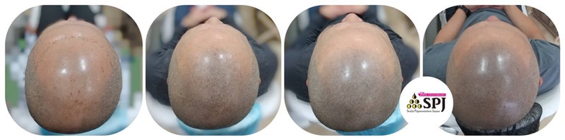 ecret Rewind〜薄毛の逆再生 ヘアアートメイクとは?【薄毛は医療タトゥーで描く時代】