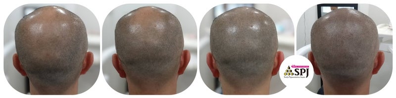 ecret Rewind〜薄毛の逆再生 ヘアアートメイクとは?【薄毛は医療タトゥーで描く時代】