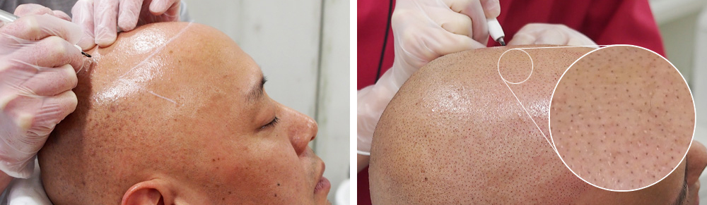 ヘアアートメイクとは?【薄毛は医療タトゥーで描く時代】